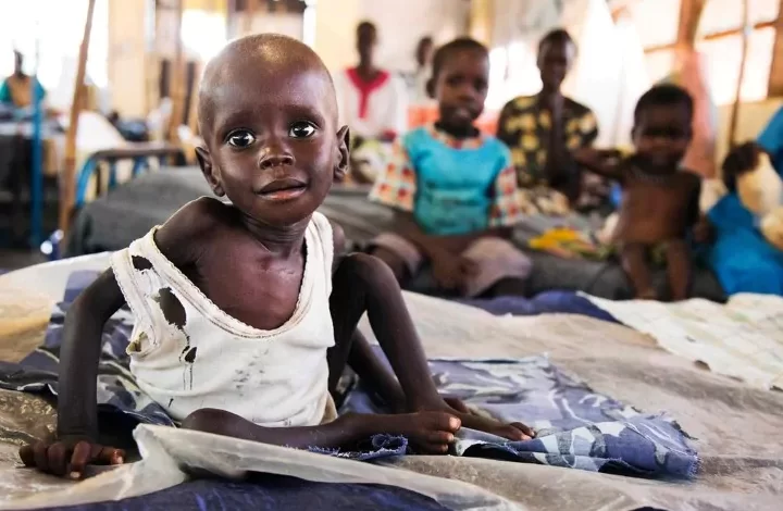 سوء التغذية عند الاطفال في السودان