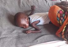 طفل مصاب بسوء التغذية- المنسقية العامة للاجئين